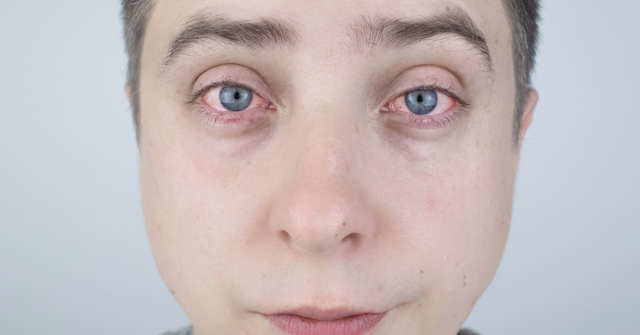 Will CBD Make Your Eyes Red?